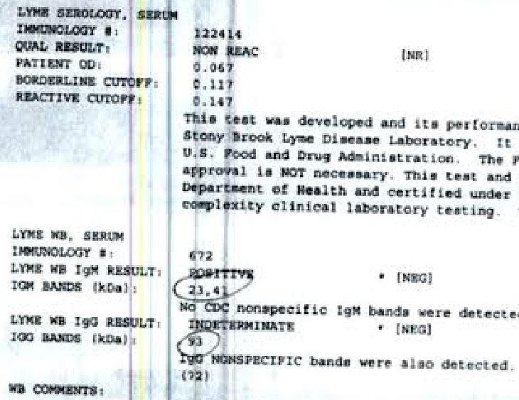 stonybrook western blot lyme edit.jpg